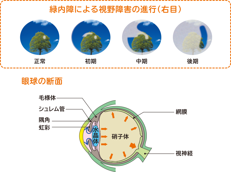 画像:緑内障による視野障害の進行（右目）