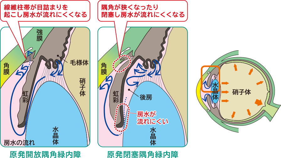 画像:原発開放隅角緑内障、原発閉塞隅角緑内障